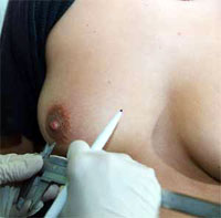 Markieren der Piercingstelle